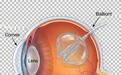 十年反复网脱、硅油乳化致眼压失控,15岁少年在汉植入新型“眼内球囊”保住眼球