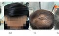 脱发五年,前额后退、头顶稀疏,37岁男子重新找回发量