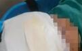 男生在青少年成长基地被打骨折,开颅手术后右眼仍无法视物,涉事教官已被警方控制