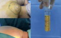 没有诊断编码的病,手术排到了 4 个月后,竟然还能用国补?