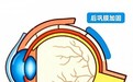 谁需要做后巩膜加固术?爱尔眼科一城四院提醒三类高风险人群需关注