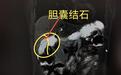 女子查出胆囊结石拖了七年没治,如今胆囊已被结石“塞满”,专家提醒:胆结石没症状也别忘了定期复查