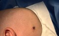 铁钉扎进3岁男童头部!家长没拔钉,医生点赞:这一步做对了