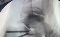 爬梯子时摔伤导致骨折,“老糖友”手术遇难题,微创手术避开伤口愈合“雷区”