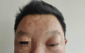 西安市第三医院:鼻窦炎反复发作?那可大意不得!
