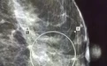 河南省肿瘤医院:早发现 精诊断 这台设备擅长“擒拿”乳腺微小病灶