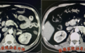 鼓医团队新辅助治疗后手术根治复发性肾癌伴静脉癌栓