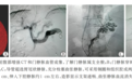 “门静脉内的都江堰工程”TIPS 市三院消化内科常年开展