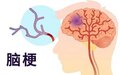 脑梗死发生时怎么办?时间就是大脑