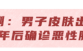 体内有癌 皮肤先知