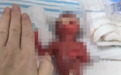 人类生存极限!全国最小!胎龄21周+4天超早产儿“肉肉”被成功救治