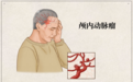 小小密网支架重塑血管 化解“不定时炸弹”破裂风险