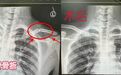 綠茵“小將”先后多處骨折，江西省兒童醫院微創復位助返賽場