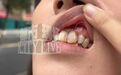 女子牙疼到南昌“一萌口腔诊所”做完根管治疗后损失一颗牙