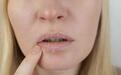体内有癌,嘴唇先知?若嘴唇出现2种情况,当心是癌症来临