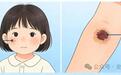 孩子身上的痣,到底该不该管?
