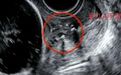 深汕中心医院产科团队成功实施极限保胎术,助濒危双胎孕妈圆“母亲梦”