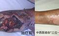济南南郊医院中西医结合“三位一体”疗法:破解老烂腿久治不愈新方案