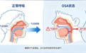 孩子打鼾≠睡得香,儿童睡眠呼吸问题,正在悄悄影响孩子成长