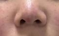 少年反复膝盖痛,医生竟查出系统性红斑狼疮!