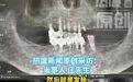 【76岁老人一次性被拔13颗牙种12颗】老人被拔13颗牙种12颗后重