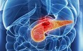 AI赋能液体活检:康德生物胰腺癌早筛早诊的数智化创新与实践