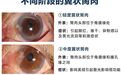 眼睛长出“小翅膀”不必愁|齐齐哈尔爱尔眼科睛致翼状胬肉手术,精细诊疗降低复发,守护眼表健康