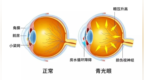 潍坊市人民医院|【节日里的健康】“世界青光眼日”免费测眼压活动