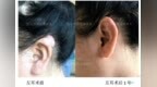 科普｜“小”耳洞也会引发“大”疙瘩，如何治疗和预防？