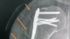 糟了！引流管断在患者体内，主任惊出一身汗，该怎么给患者解释？