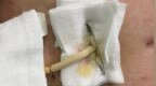 糟了！术后 T 管拔不出来了