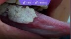 舌头「发霉」长出一簇白毛，这个小伙怎么了？