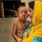 八岁小孩竟老如耋耄，面容畸形满脸褶皱