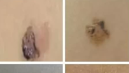 惊呆了！洗澡搓破一颗痣三年没治竟变成癌