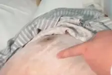 男子被毒蛇咬伤
