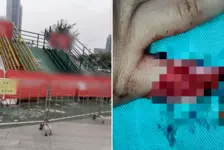 女童玩滑梯夹断小拇指