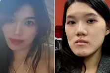 女孩被整成“鞋拔子脸”