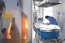 电动车爆炸烧伤男童