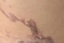女生拔罐着火致多处烧伤
