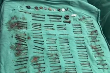 男子胃中取出180颗铁钉