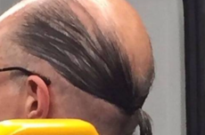 秃头有救了！英国科学家要用骨质疏松药治疗秃顶