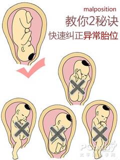 两个秘诀快速纠正异常胎位