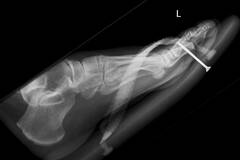 被奇怪物体入侵身体时的X射线影像