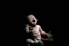 剖腹产出生18秒的婴儿