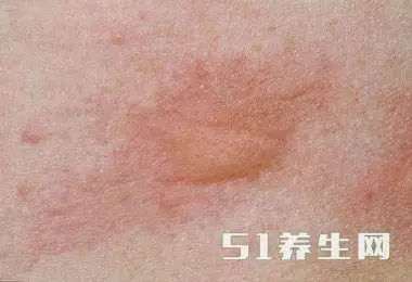 一旦得了荨麻疹，这3种食物要避而远之，别一意孤行_图1