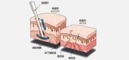 云南吸脂多少钱常见的4种吸脂方法云南铜雀台美容医院