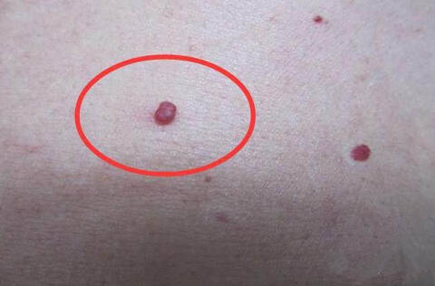 肝病早期不痛不痒,身上长出这2种痣,要警惕肝