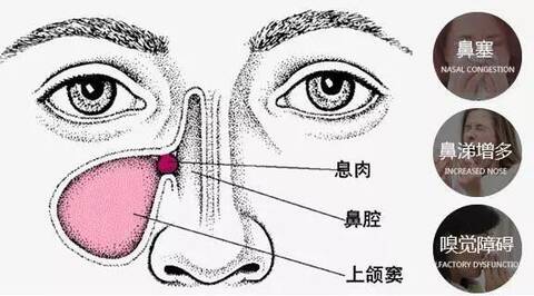 鼻窦炎与腺样体肥大的关系