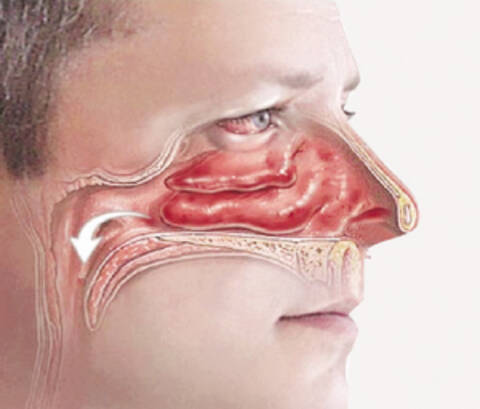 专家详解鼻中隔偏曲和鼻甲肥大 长沙九龙耳鼻