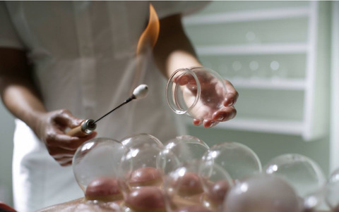 拔火罐示意固:`